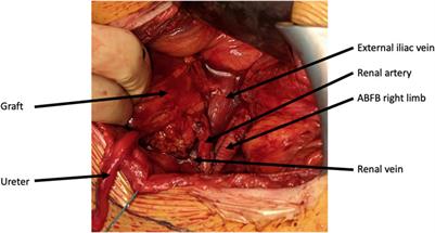 Aortobifemoral Bypass in Kidney Transplant Candidates: A Ten-Year Experience